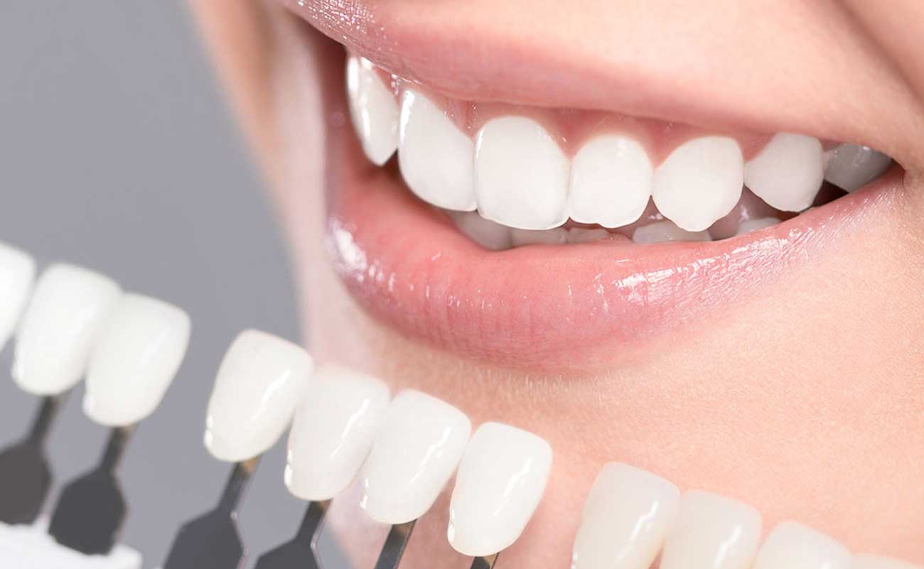 Impact of Whitening Mouthwash on Teeth Whitening Treatment